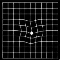 macular-degeneration