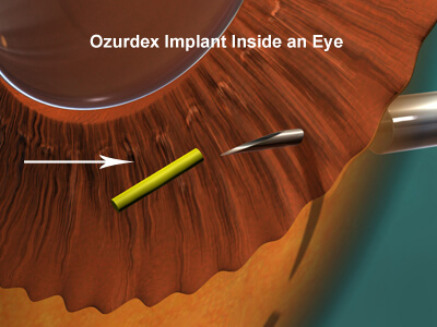 Ozurdex implants