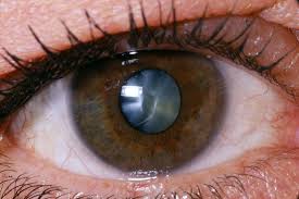 advanced-retinal-cataract-surgery