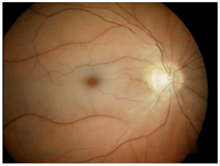 central-retinal-artery-occlusion