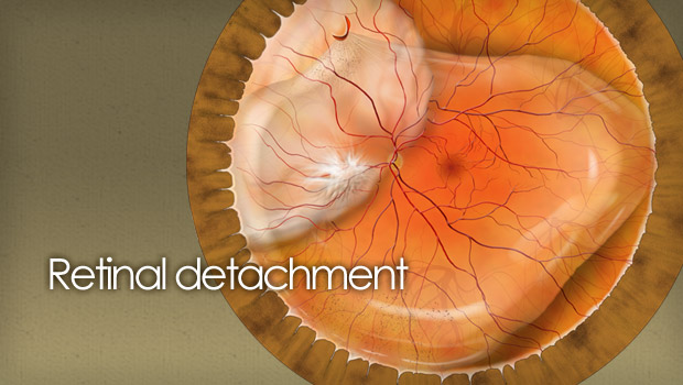 retinal-detachment