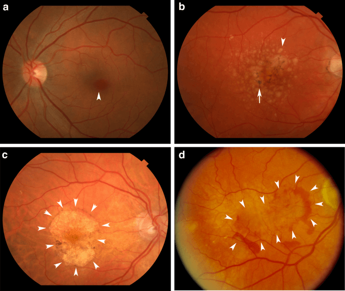 macular-degeneration