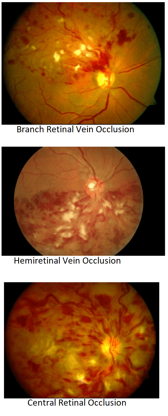 Retinal-Vein-Occlusion